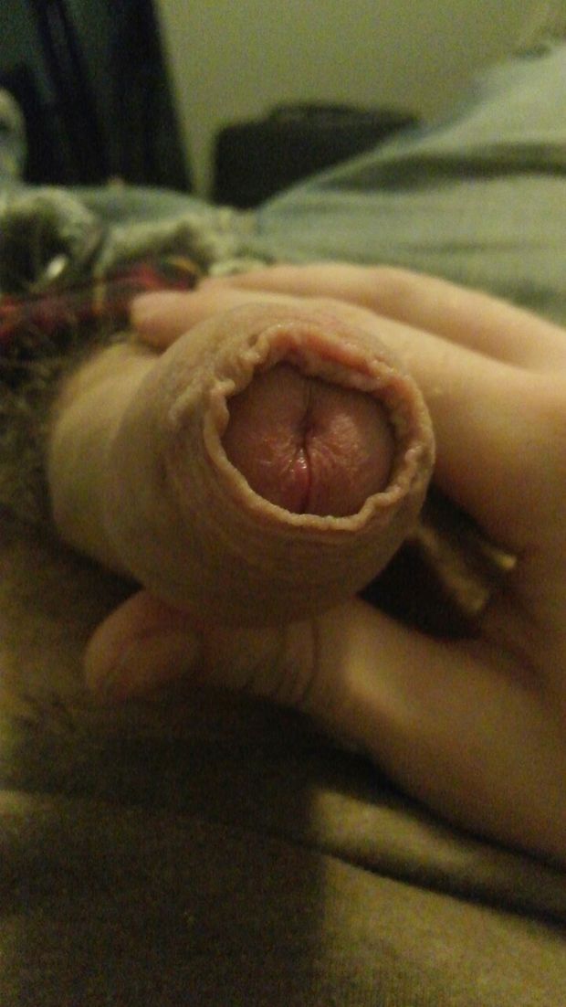 Open Foreskin