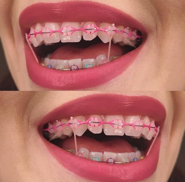 Braces elastics