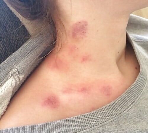 Give her some hickey !