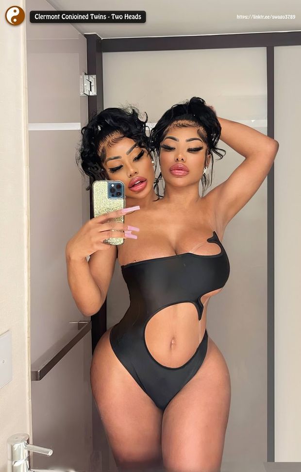 Clermont Twins Conjoined - Two Heads